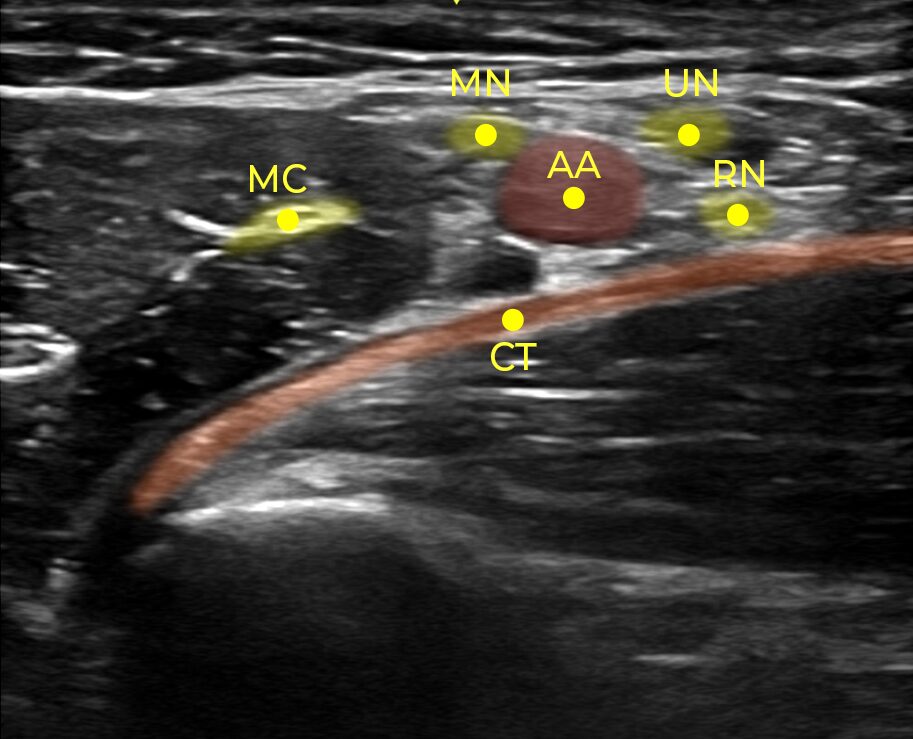 Axillary ultrasound scan comparison — traditional image versus SmartAlpha AI structure overlay