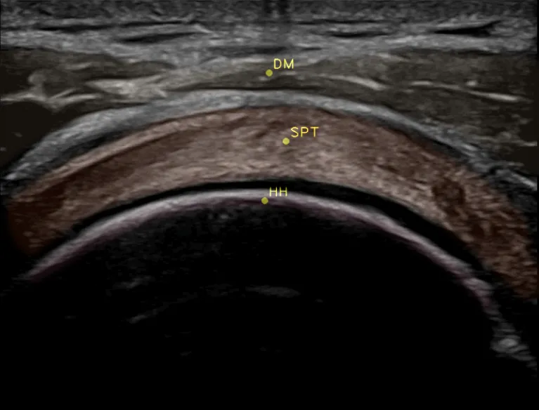 Shoulder ultrasound scan comparison — traditional image versus MSK Go structure overlay
